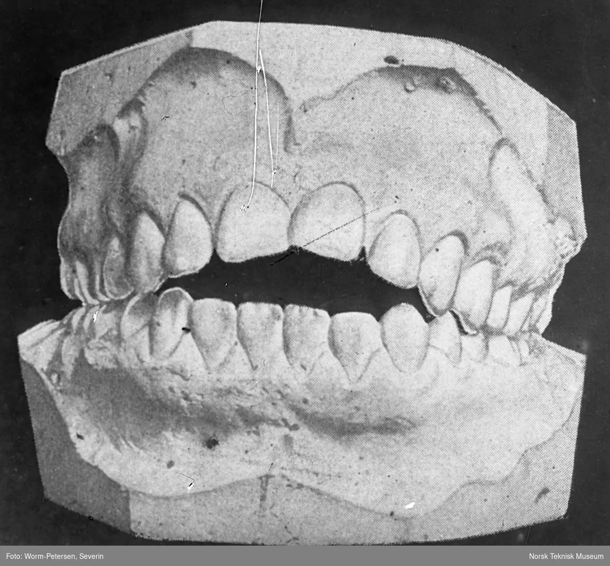 Tannstilling, åpning mellom tenner i over- og underkjeven