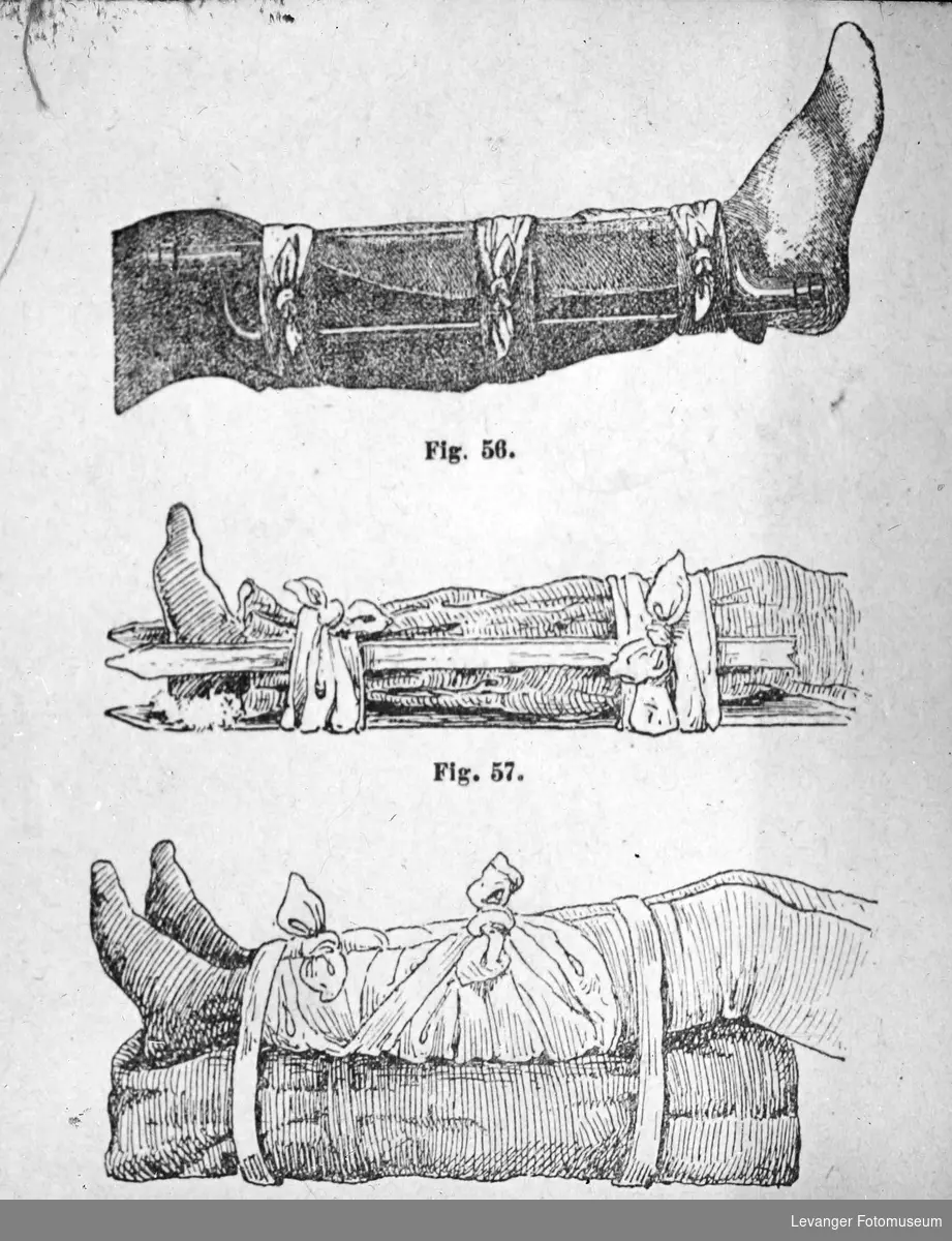 Tegning fra medisinsk håndbok, viser spjelking av bein.