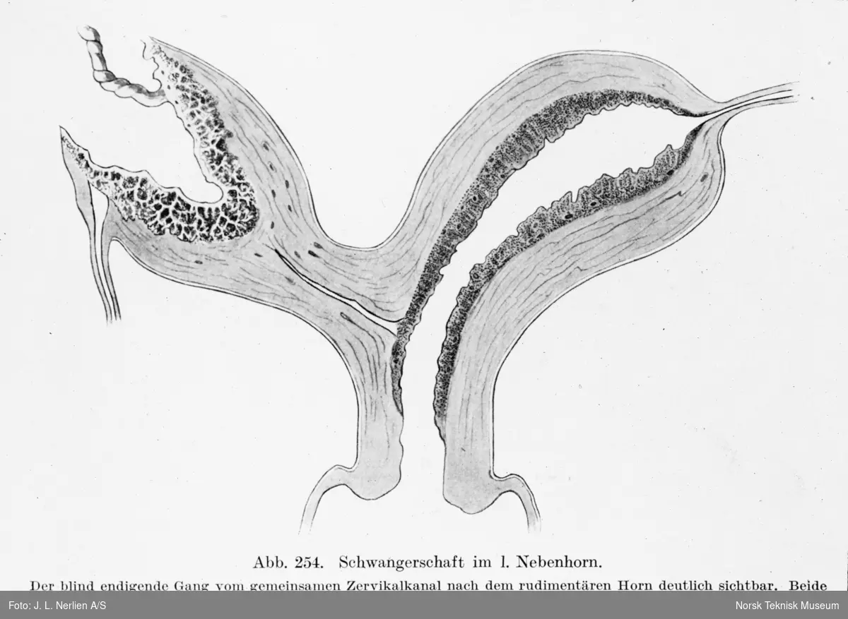 Avfotografert tegning av svangerskap i den første sidelinje i "enhjørning livmor", uterus unicornis