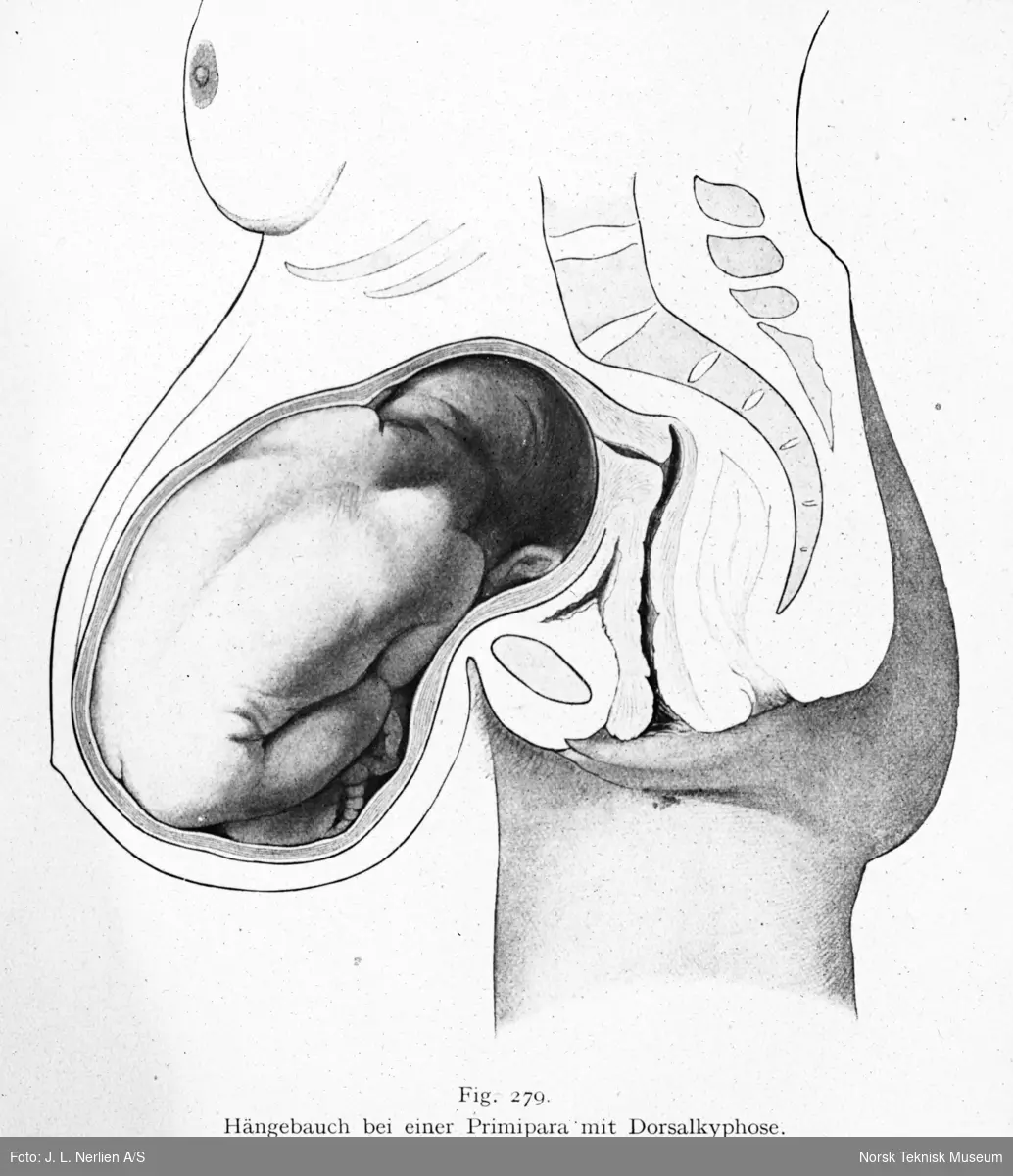 Avfotografert tegning av slapp mage i en førstegangsfødsel i en kvinne med krumming av ryggraden, ryggkyfose