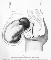 Avfotografert tegning av slapp mage i en førstegangsfødsel i