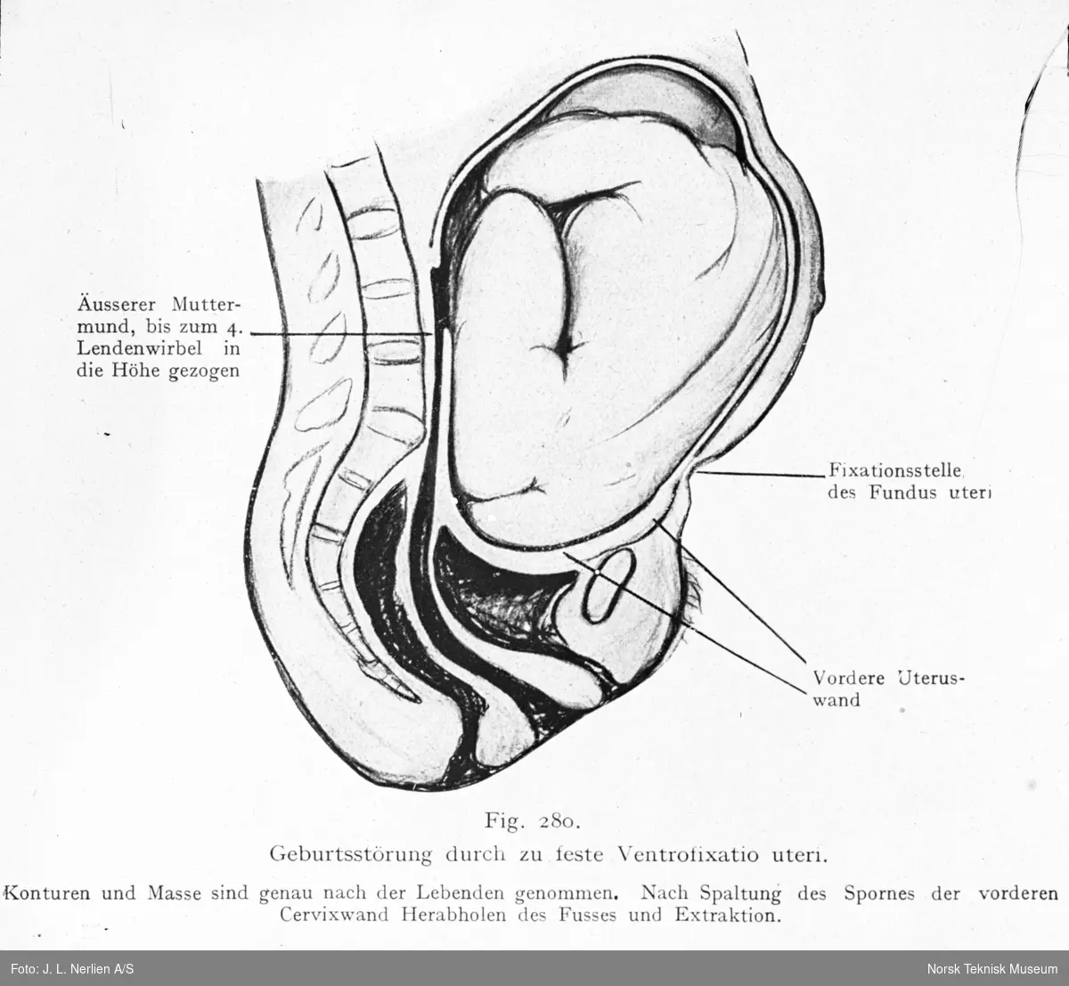 Avfotografert tegning av fødselsforstyrrelse på grunn av for stram livmor, ventrofixatio uteri