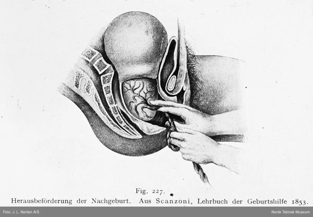 Avfotografert tegning av demonstrasjon av utvidelsen av skjeden etter fødselen